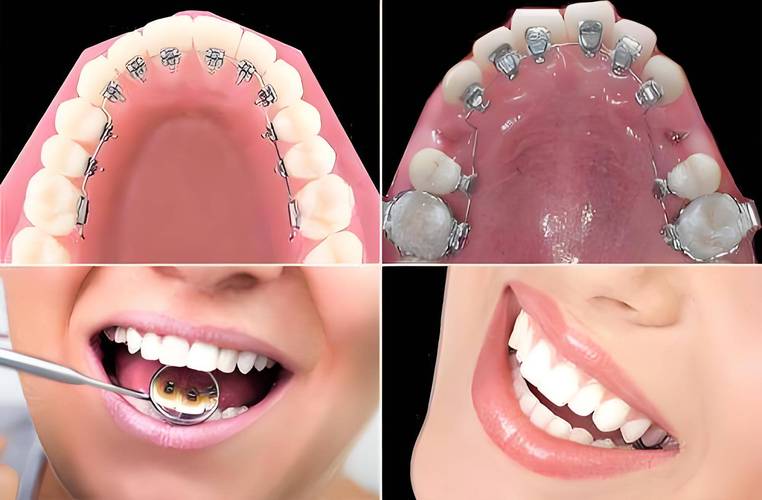 牙齿矫正图片侧面-图1