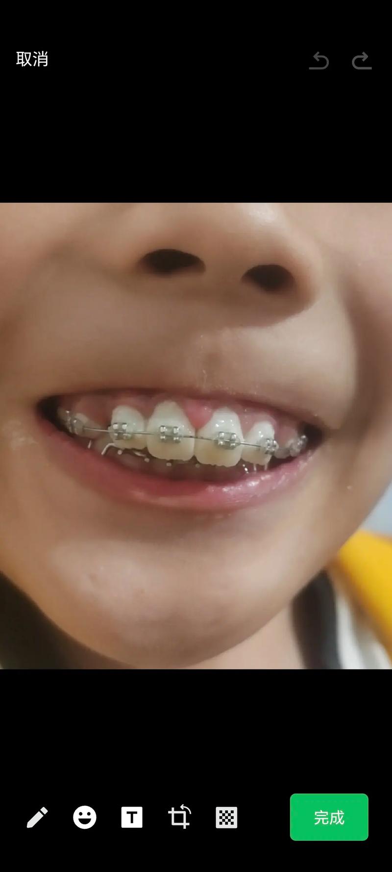 小孩牙齿稀疏该矫正吗？最佳矫正时机是什么时候？-图1