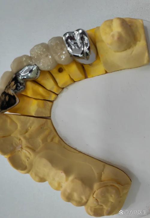 南京矫正牙齿和镶牙，哪个更适合你的牙齿问题？-图1