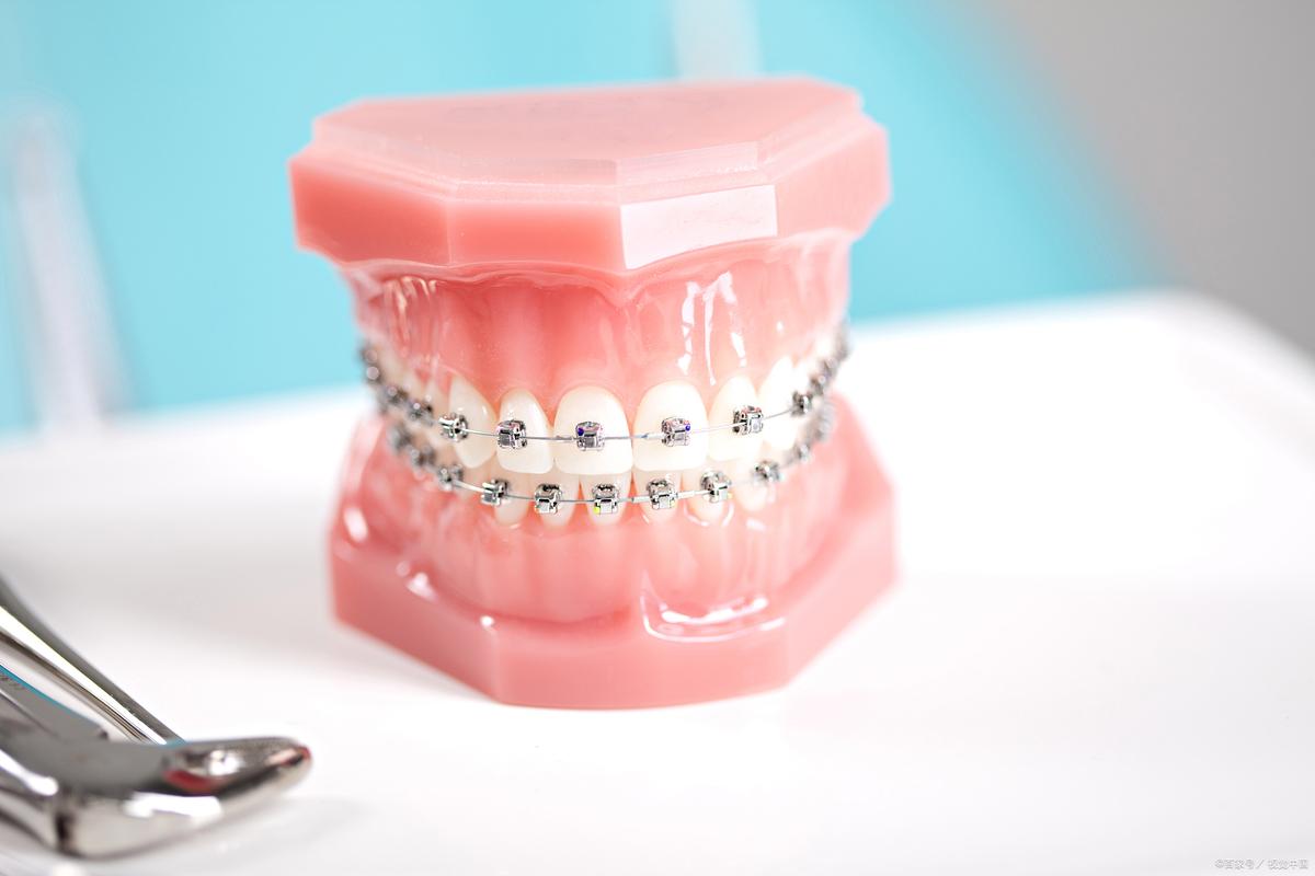 南京矫正牙齿和镶牙，哪个更适合你的牙齿问题？-图3