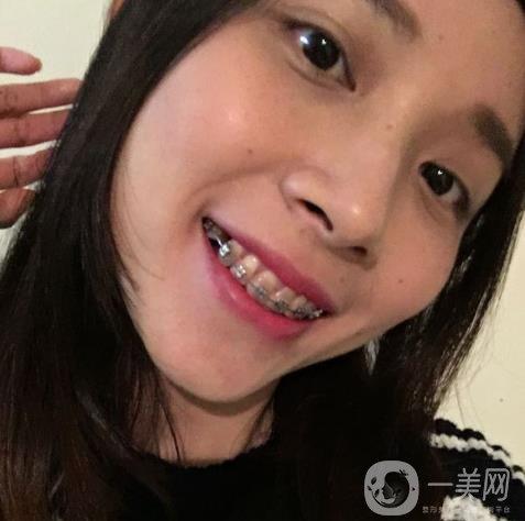 光华口腔矫正牙齿-图1