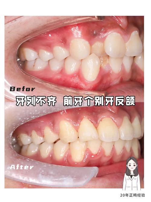 矫正牙齿前排不齐-图1 矫正牙齿前排不齐-图1