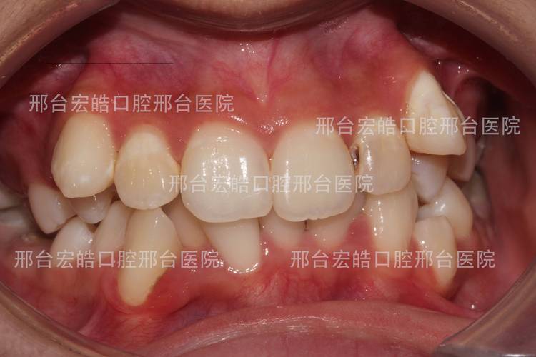 牙齿矫正最后不齐-图2