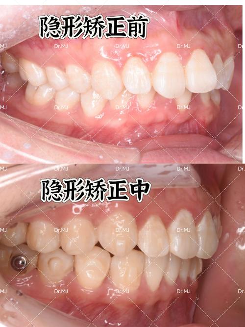 牙齿不齐选隐形矫正?效果与注意事项有哪些?-图3 牙齿不齐选隐形矫正?效果与注意事项有哪些?-图3