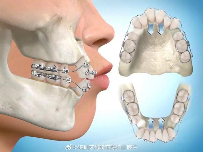 牙齿矫正拔牙?哪种情况必须拔?-图2 牙齿矫正拔牙?哪种情况必须拔?-图2
