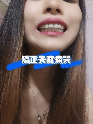 中年矫正牙齿后悔，这些坑你踩了吗？-图1