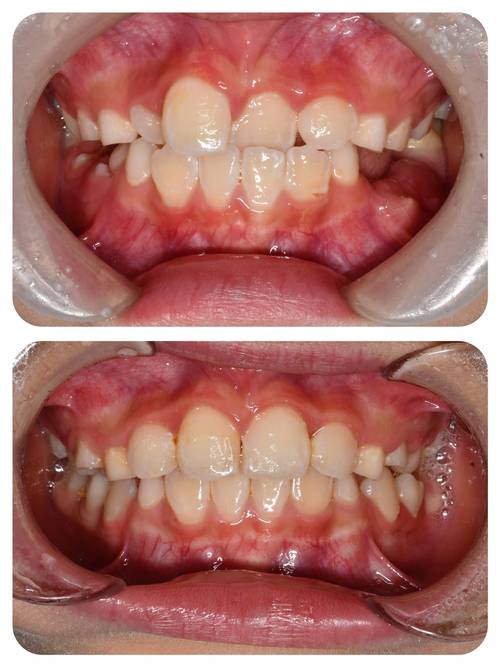 儿童牙齿矫正何时开始最合适？-图3