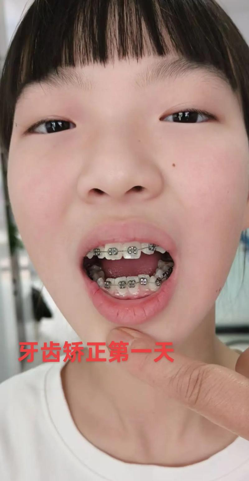 开封卫校学生矫正牙齿，价格、流程及效果如何？-图2