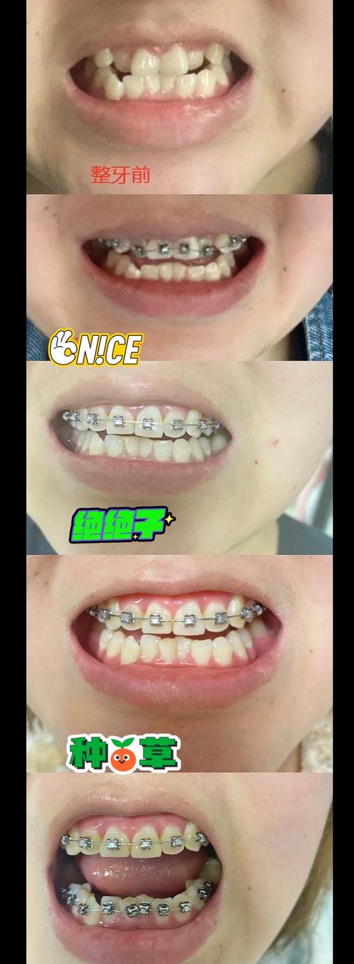开封卫校学生矫正牙齿，价格、流程及效果如何？-图3