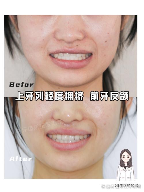 牙齿矫正不在中线-图2