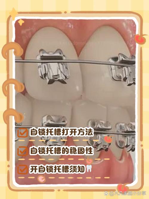 矫正牙齿 游离钩-图2 矫正牙齿 游离钩-图2