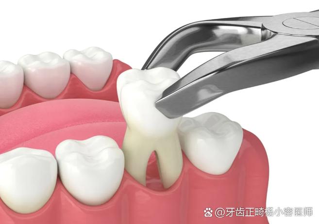 拔牙矫正一般拔几颗牙？数量如何确定？-图1