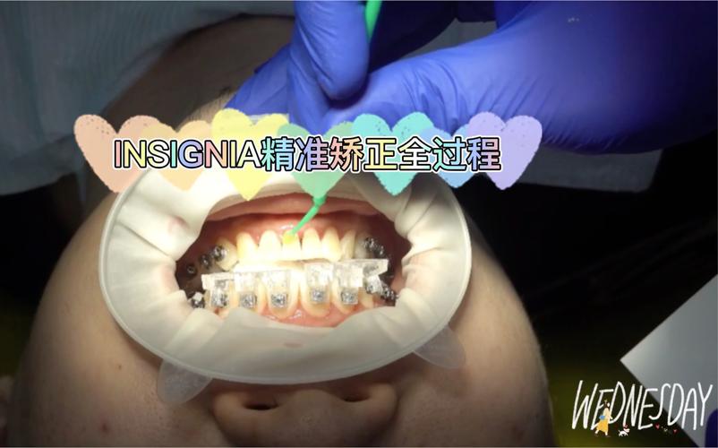 牙齿矫正托槽粘贴-图2 牙齿矫正托槽粘贴-图2