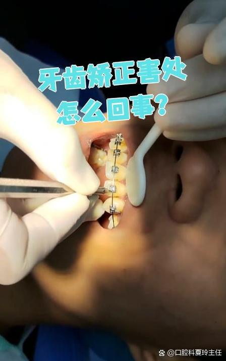 牙齿矫正发现龋齿-图2