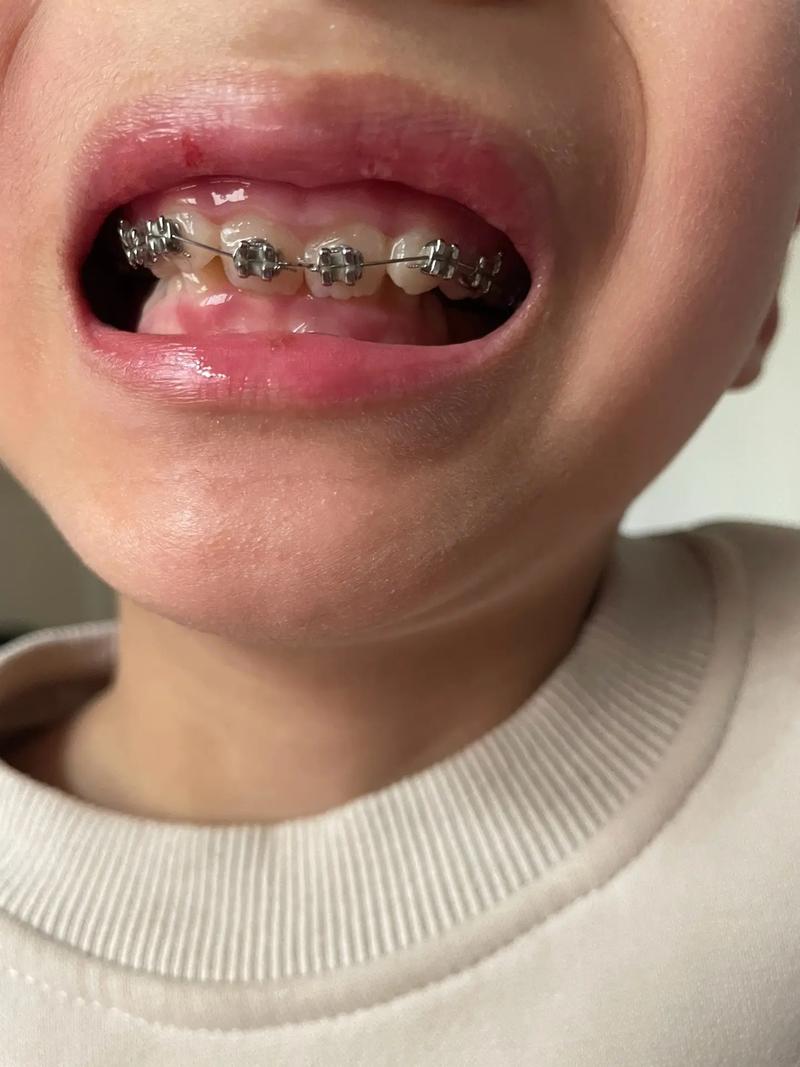 小孩牙齿矫正酸痛？原因和缓解方法是什么？-图1