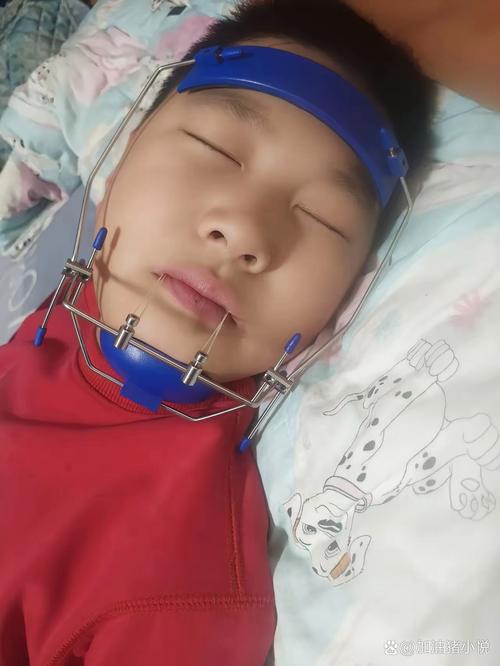 小孩牙齿矫正酸痛？原因和缓解方法是什么？-图2