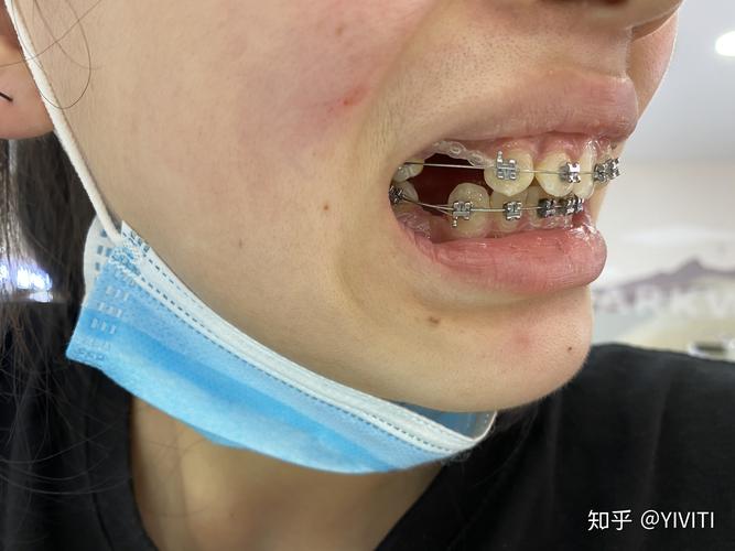 上海哪些牙齿矫正-图2