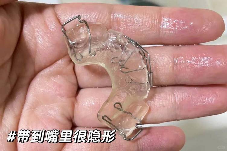 矫正牙齿能把外露的牙齿矫正好吗？-图1