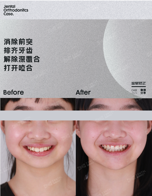 矫正牙齿能把外露的牙齿矫正好吗？-图3