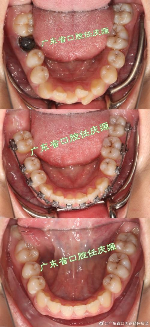 广州传统矫正效果如何？价格流程有哪些？-图3