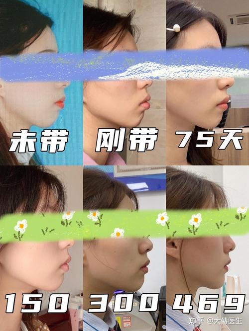 矫正牙齿 高颧骨-图3 矫正牙齿 高颧骨-图3