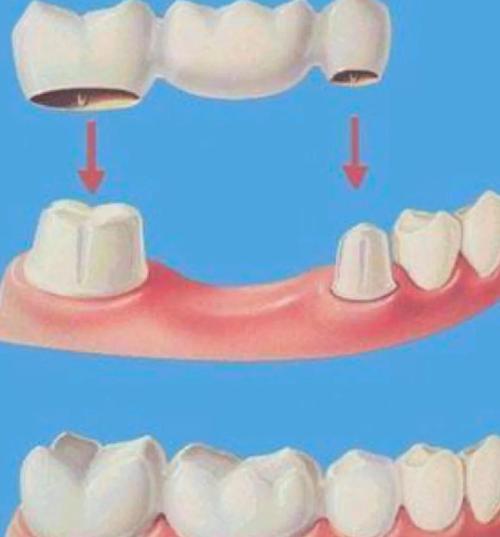 牙齿矫正能用烤瓷牙吗?效果及注意事项有哪些?-图3 牙齿矫正能用烤瓷牙吗?效果及注意事项有哪些?-图3