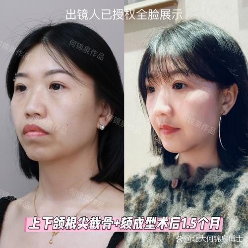 牙齿矫正能代替突嘴手术吗？-图1