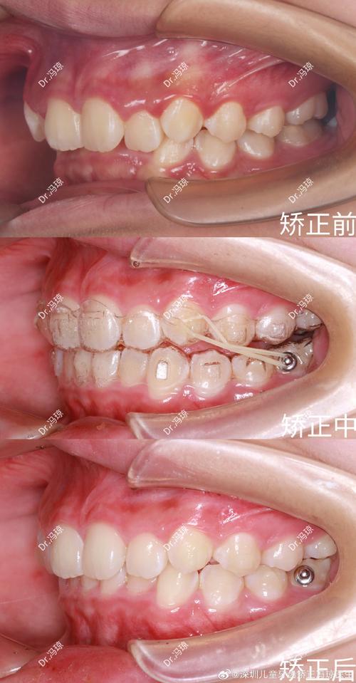 矫正咬合不齐牙齿，具体该怎么做？-图1