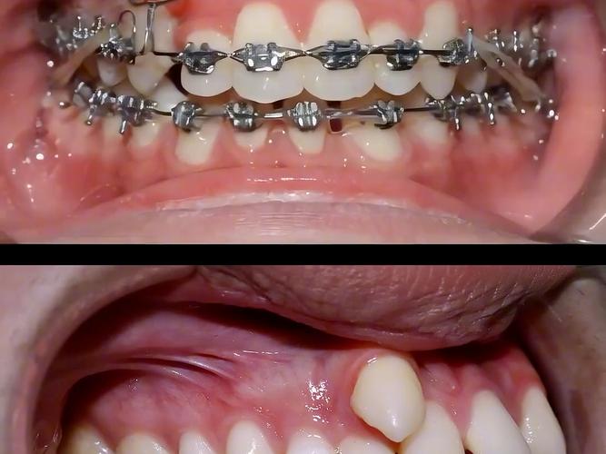 牙齿轻微拥挤矫正有必要吗？方法有哪些？-图1