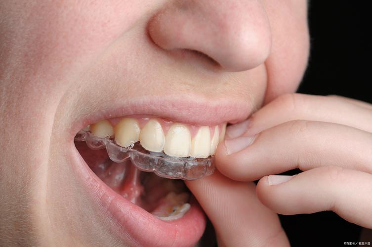 隐形矫正牙齿整形真的安全有效吗?效果能维持多久?-图2 隐形矫正牙齿整形真的安全有效吗?效果能维持多久?-图2