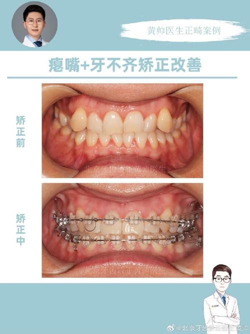 门牙内倾矫正难？原因与办法解析-图2