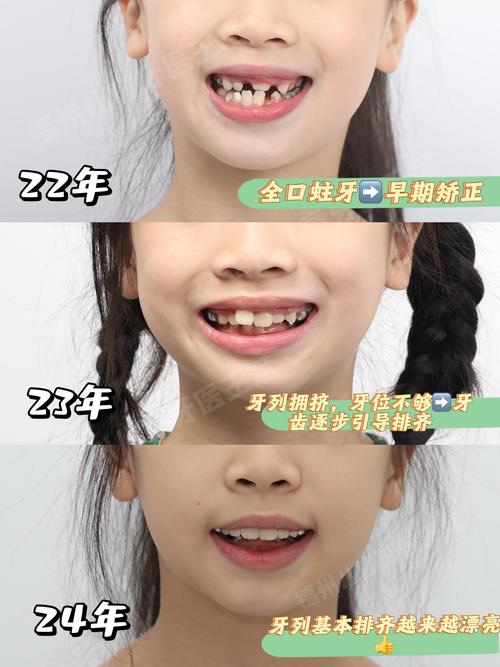 门牙内倾矫正难？原因与办法解析-图3