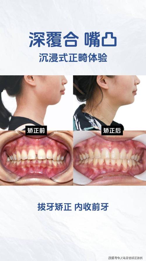 牙齿矫正后咬合太深,是什么原因导致的?该如何有效处理?-图2 牙齿矫正后咬合太深,是什么原因导致的?该如何有效处理?-图2