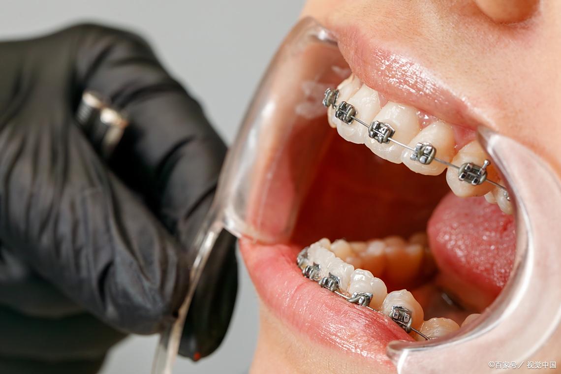 金属冰晶矫正牙齿与传统矫正有何不同？-图3