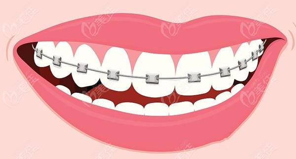 南京江宁矫正牙齿哪家好?效果靠谱吗?价格贵不贵?-图3 南京江宁矫正牙齿哪家好?效果靠谱吗?价格贵不贵?-图3