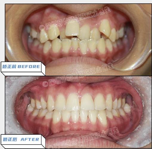 深圳牙齿矫正如何选择靠谱方法与机构？-图1