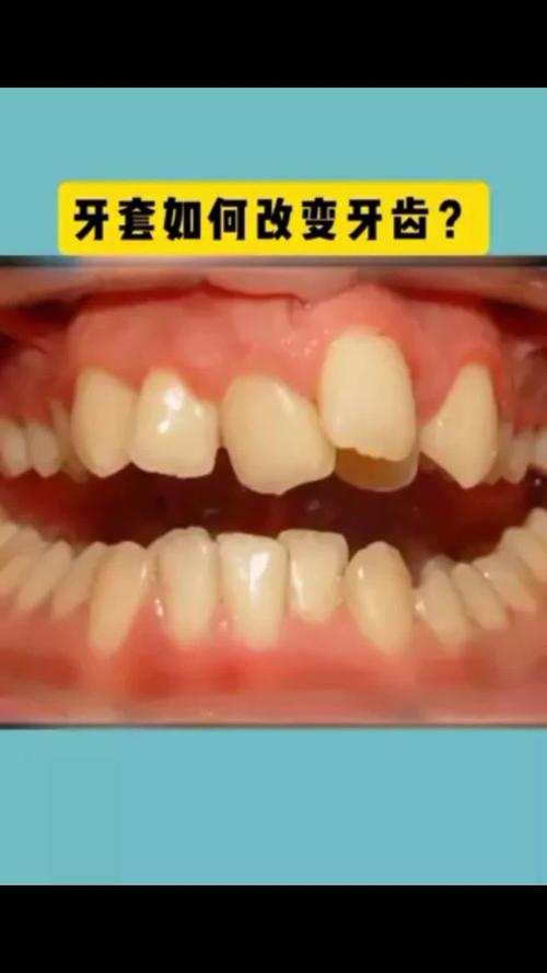 深圳牙齿矫正如何选择靠谱方法与机构？-图2