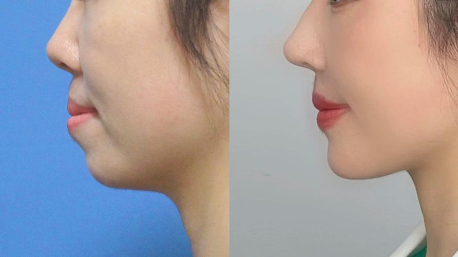 矫正牙齿前后侧面变化有多大？-图2