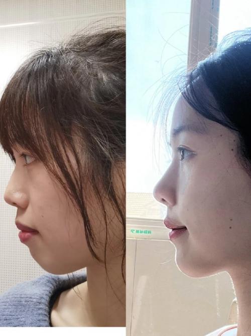 矫正牙齿前后侧面变化有多大？-图3