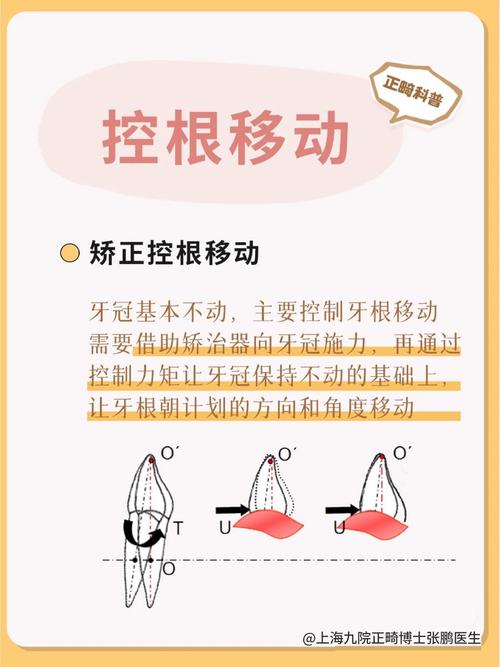 矫正中牙齿移动遵循哪些核心规律?-图2 矫正中牙齿移动遵循哪些核心规律?-图2