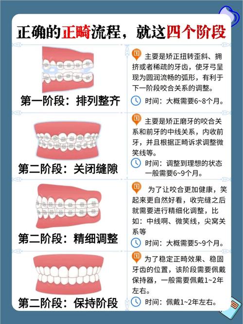 矫正中牙齿移动遵循哪些核心规律?-图3 矫正中牙齿移动遵循哪些核心规律?-图3