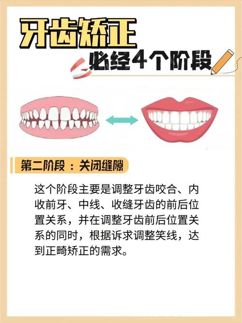 牙齿矫正到底几岁做最合适?过早或过晚会有哪些影响?-图2 牙齿矫正到底几岁做最合适?过早或过晚会有哪些影响?-图2