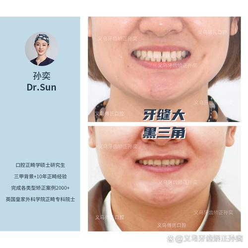 牙齿矫正类型案例怎么选?哪种更适合自己?-图2 牙齿矫正类型案例怎么选?哪种更适合自己?-图2