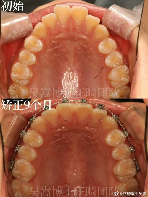南京矫正牙齿选哪家医院更专业靠谱?-图3 南京矫正牙齿选哪家医院更专业靠谱?-图3
