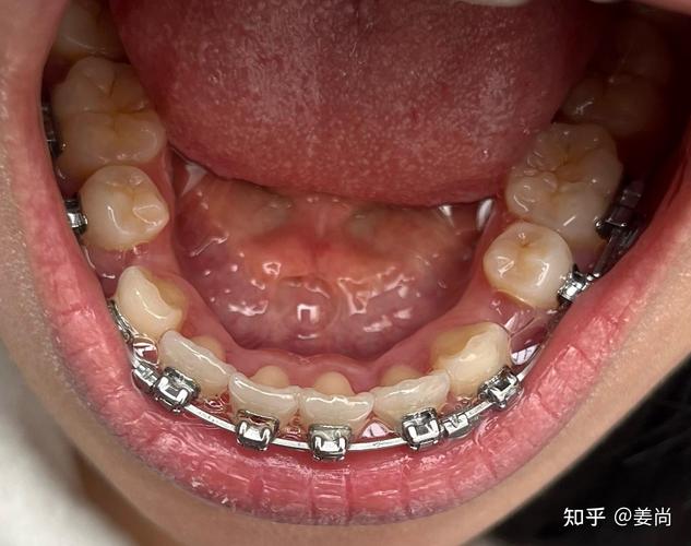 成都牙科矫正牙齿,效果好不好价格贵不贵怎么选?-图2 成都牙科矫正牙齿,效果好不好价格贵不贵怎么选?-图2