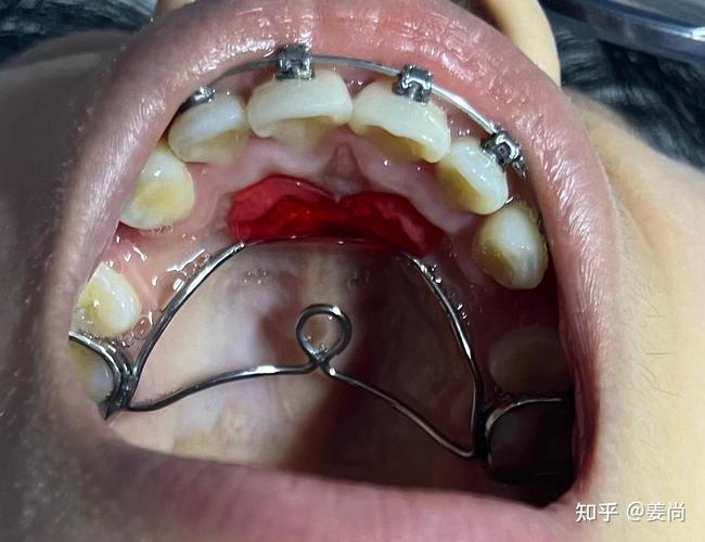 成都牙科矫正牙齿,效果好不好价格贵不贵怎么选?-图1 成都牙科矫正牙齿,效果好不好价格贵不贵怎么选?-图1