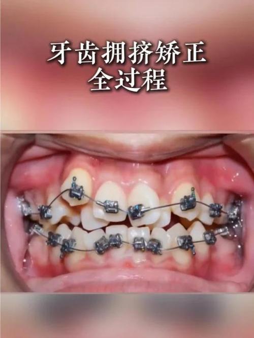 牙齿拥挤需要矫正吗？-图2