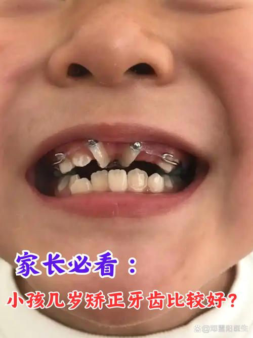 儿童牙齿矫正，何时做最合适？早干预真的有必要吗？-图2