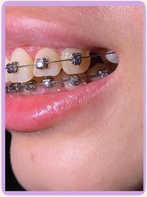 矫正牙齿加力太大，会导致牙齿松动吗？-图2