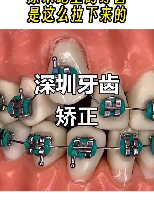 深圳学生矫正牙齿-图3
